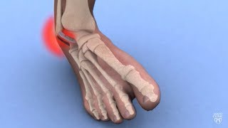 Mayo Clinic Minute Ankle sprains 101 [upl. by Lindell]