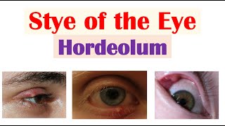 Eye Stye Hordeolum  Causes Symptoms Diagnosis amp At Home Treatments [upl. by Anastos]