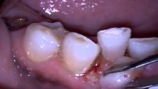 MD Epulis Removal [upl. by Karub]