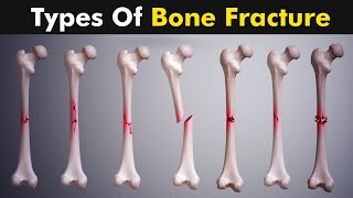 Breaking Down Femur Fractures  What You Need to Know [upl. by Enenstein]