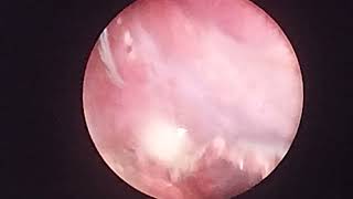 laparoscopic appendectomy in appendicular lump [upl. by Branham]