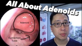 Adenoids and Adenoidectomy what are they when do we remove them what is the surgery like [upl. by Hobbs946]