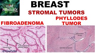 Diseases of Breast Part 3 Fibroadenoma amp Phyllodes tumor [upl. by Arikaahs]