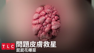 《問題皮膚救星》屁屁花椰菜，看不見不代表不存在的痛｜TLC 旅遊生活頻道 [upl. by Arawaj233]