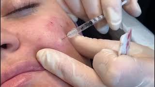 INTRADERMAL BOTOX THERAPYquotbeautytricks [upl. by Valonia421]