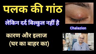 पलक में गांठ  कारण  इलाज  घर का बाहर का  Home Remedies Chalazion [upl. by Hobard]