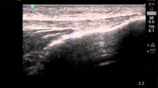 Comment  Réaliser un examen échographique du tendon rotulien [upl. by Sitruk698]