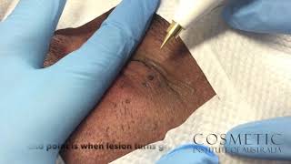 dermatosis papulosa nigra removal with radio frequency [upl. by Zelma]