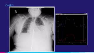 Pulmonary Case 5 Presented at RSNA 2018  Konica Minolta Healthcare [upl. by Krenek]