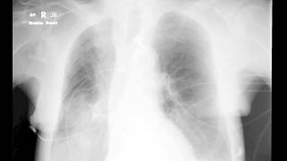 Pulmonary infiltrates in ICU [upl. by Blodget937]