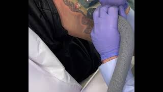 Tatueringsborttagning med Pico Laser Lutronic PicoPlus [upl. by Dej]