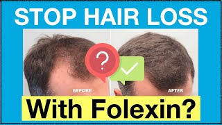 How Does Folexin Really Work To Stop Hair Loss Naturally See Our FolexinFoligen Review [upl. by Gaves956]