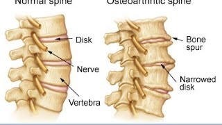 Anatomy of Spinal Arthritis Explained by Top Pain Doctor in Las Vegas Nevada [upl. by Cerveny40]