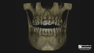 ANTES Y DESPUES CON IMPLANTES DENTALES [upl. by Richarda]