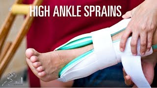 High ankle sprain Signs symptoms and treatment of a syndesmosis injury [upl. by Anifesoj689]