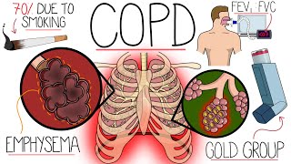 Understanding Chronic Obstructive Pulmonary Disease COPD Explained Clearly [upl. by Quackenbush]