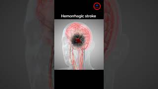 The goal of Treat Hemorrhagic stroke  stroke bleeding [upl. by Burleigh]