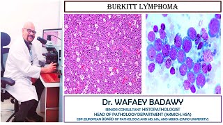 BURKITT LYMPHOMA BY DR WAFAEY BADAWY [upl. by Atiuqet]