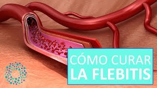 FLEBITIS Qué es y CÓMO CURARLA [upl. by Orin]