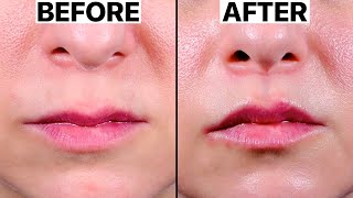 Best Lip Lift Surgery  2023 [upl. by Nednil]