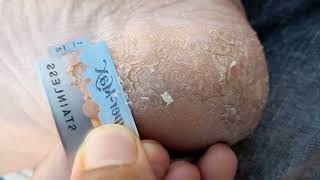 Removing Calluses At Home  Do Thiscallusremoval balckheadremove shorts youtubevideo [upl. by Wilber]