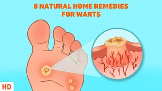 8 Surprising Home Remedies for Warts  Get Rid of Them Naturally [upl. by Kelsi383]