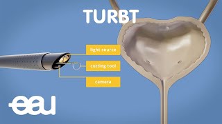 Bladder cancer treatment TURBT [upl. by Sothena216]