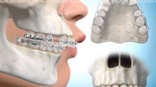 Extractions de dents pour correction surplomb horizontal [upl. by Yzeerb877]