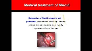 Fibroid All about management [upl. by Hada60]