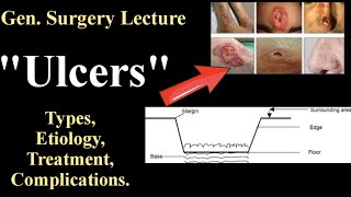 Ulcers General Surgery Lecture ClassificationEtiologyTreatment ComplicationsBDSMBBS Lecture [upl. by Trumann969]