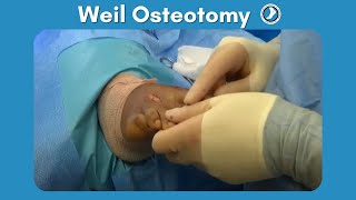 Weil Osteotomy Performed by Dr Paul Steinke [upl. by Hilario794]