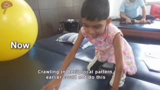 Spastic Quadriplegic Cerebral Palsy Treatment Results  Quick Look  No 3413 [upl. by Henrion]