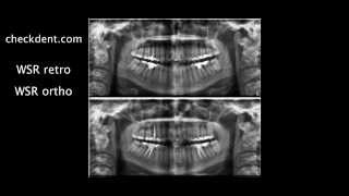 Wurzelspitzenresektion versus Endodontie [upl. by Onifur]