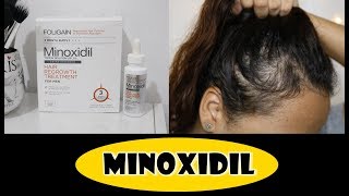 MINOXIDIL  Resultado em 3 meses Foligain [upl. by Thomsen]