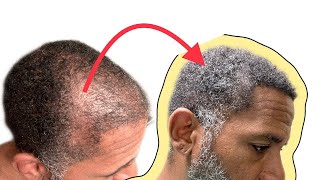 MY ASLI TARCAN REVIEW 9 MONTH POST OP HAIR TRANSPLANT [upl. by Eamon728]