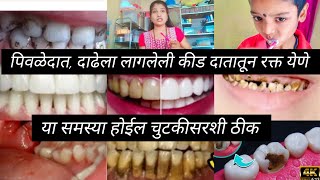 घरातील वस्तू वापरून दातातील समस्या होतील दूर teeth tips  teeth home remedies kichantips [upl. by Hitoshi]