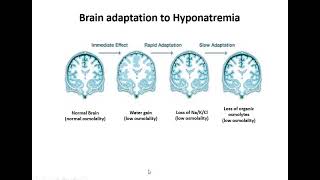 Management of Hyponatremia amp Hypernatremia in ICU By Dr Bikram Gupta [upl. by Kubiak64]