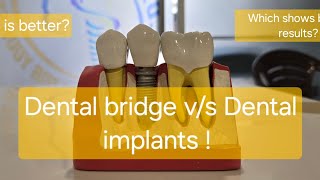 Dental bridge vs Dental implants [upl. by Ahsitahs]