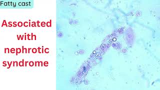 quotCasts in urine and Their Significance in Renal Disordersquot [upl. by Aisylla]