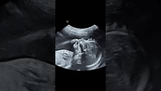 21 weeks baby sonography pregnancy mother ultrasound fetus [upl. by Hairym]