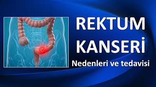 REKTUM KANSERİ Nedenleri ve Tedavisi [upl. by Ide]