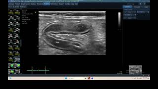 IQ 304 PANCREATIC ULTRASOUND ECHOPAC ANALYSIS [upl. by Vento]