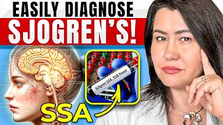 How to Diagnose Sjogrens Disease [upl. by Eeryn]