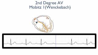 2nd Degree AV Block Mobitz Type 1 Wenckebach [upl. by Calica124]