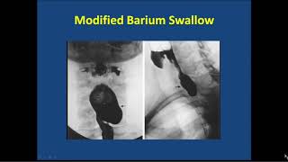 An Approach to Dysphagia [upl. by Nniuqal]