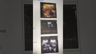 My pregnancy scan report  7th week scan ultrasound Scan pregnancy pregnancyscan [upl. by Cagle]