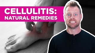 Are There Natural Remedies for Cellulitis [upl. by Ahon863]