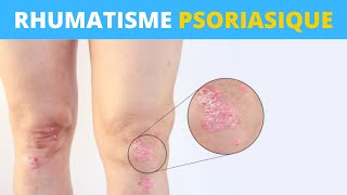 Le rhumatisme psoriasique expliqué en 1 minute [upl. by Chaille]