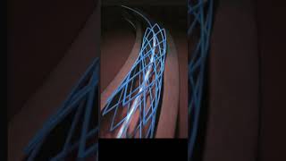 3D Animation Shows How Angioplasty Opens Artery Blockage [upl. by Ellenej]