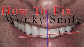 How to fix a Wonky Smile [upl. by Nirhtak]